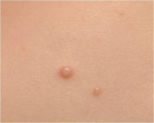 molluscum-contagioso52379